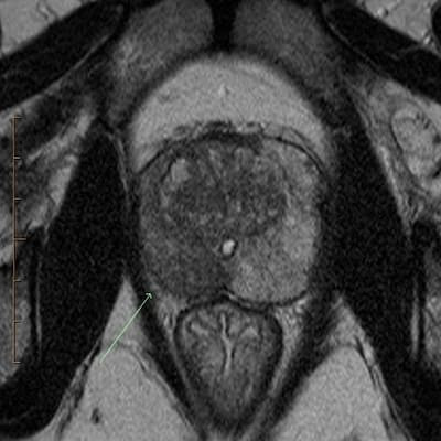 Предстательная железа на МРТ снимке